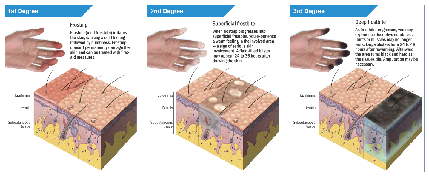 Frostbite 411 Diagnosis, Treatment, and Prevention RECOIL OFFGRID