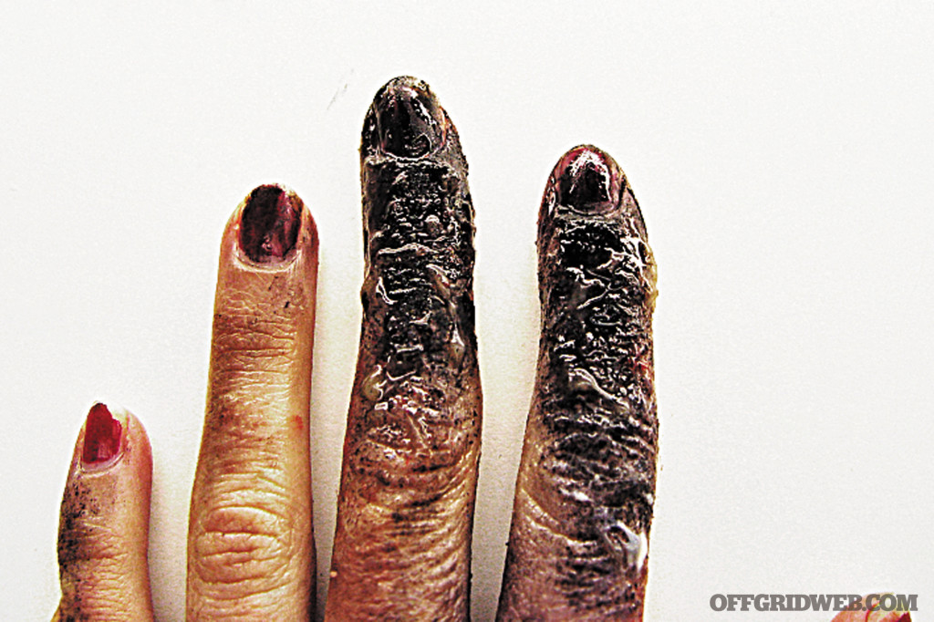 Burn survival first second third degree first aid medical trauma injury fire shtf 2