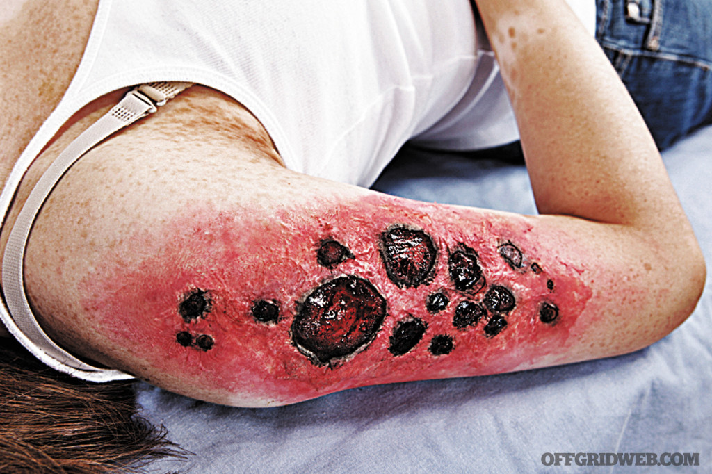 Burn survival first second third degree first aid medical trauma injury fire shtf 3