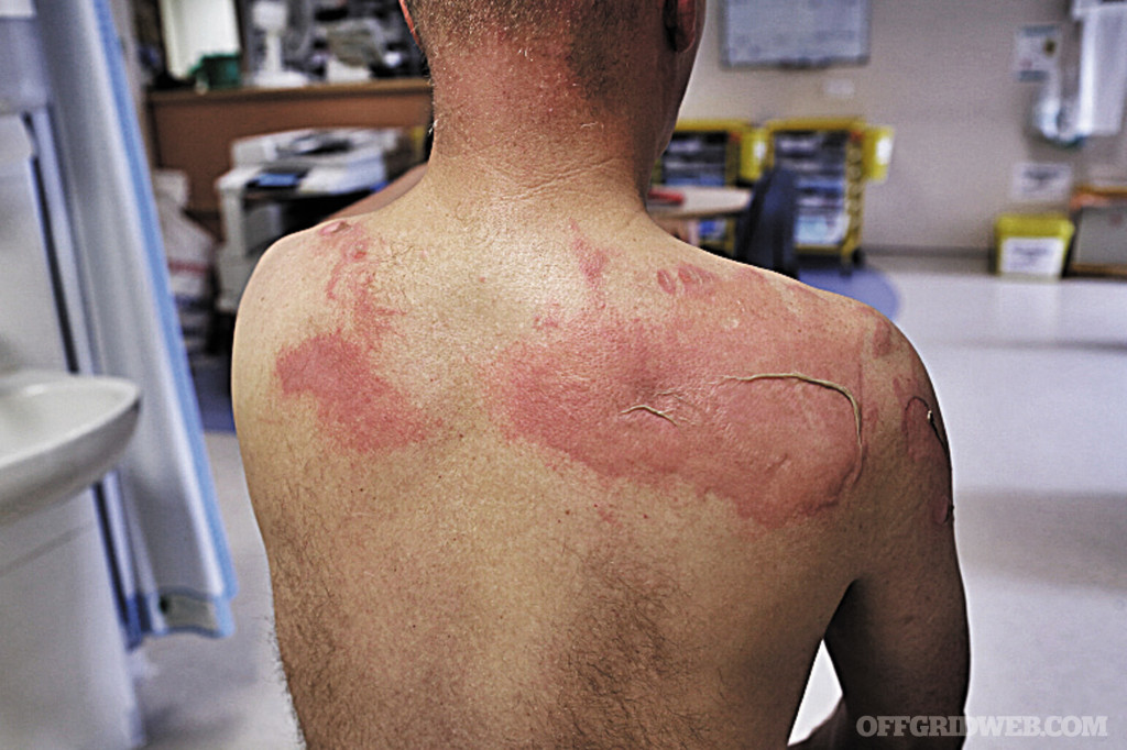 Burn survival first second third degree first aid medical trauma injury fire shtf 7