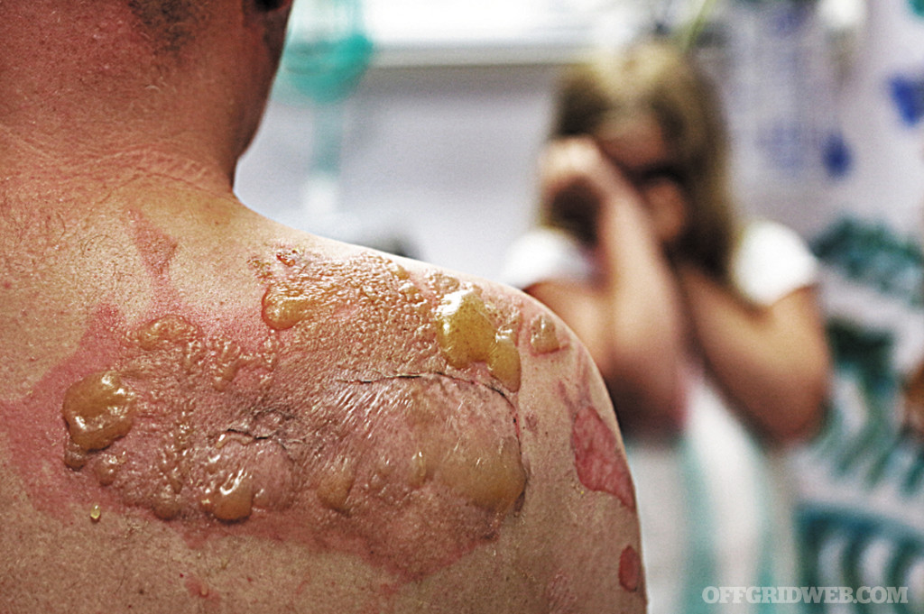 Burn survival first second third degree first aid medical trauma injury fire shtf 8