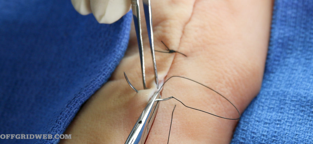 diy suture guide