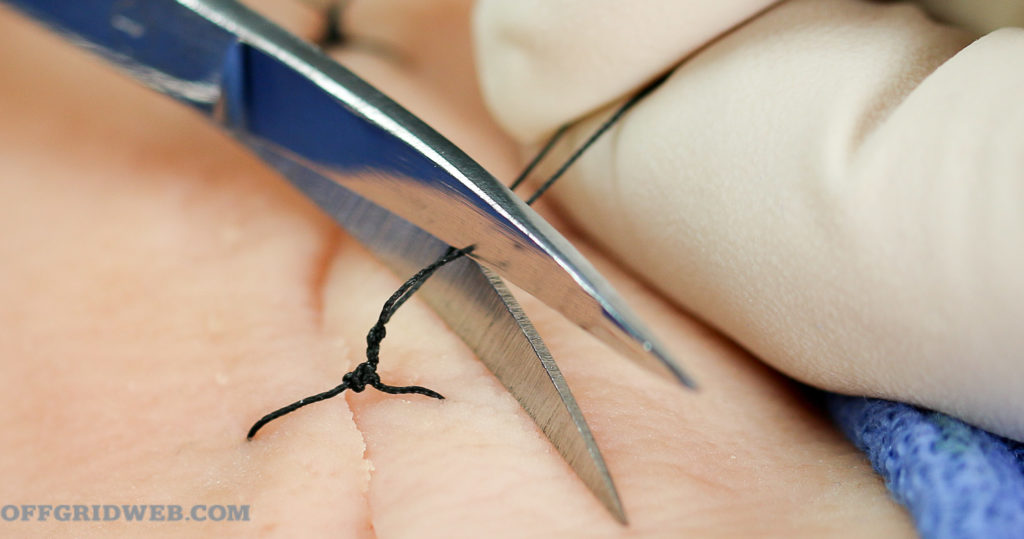 suture guide