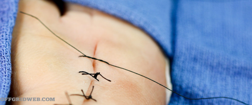 how to suture
