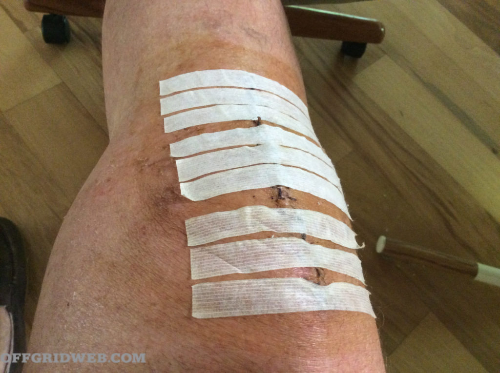 sutured knee