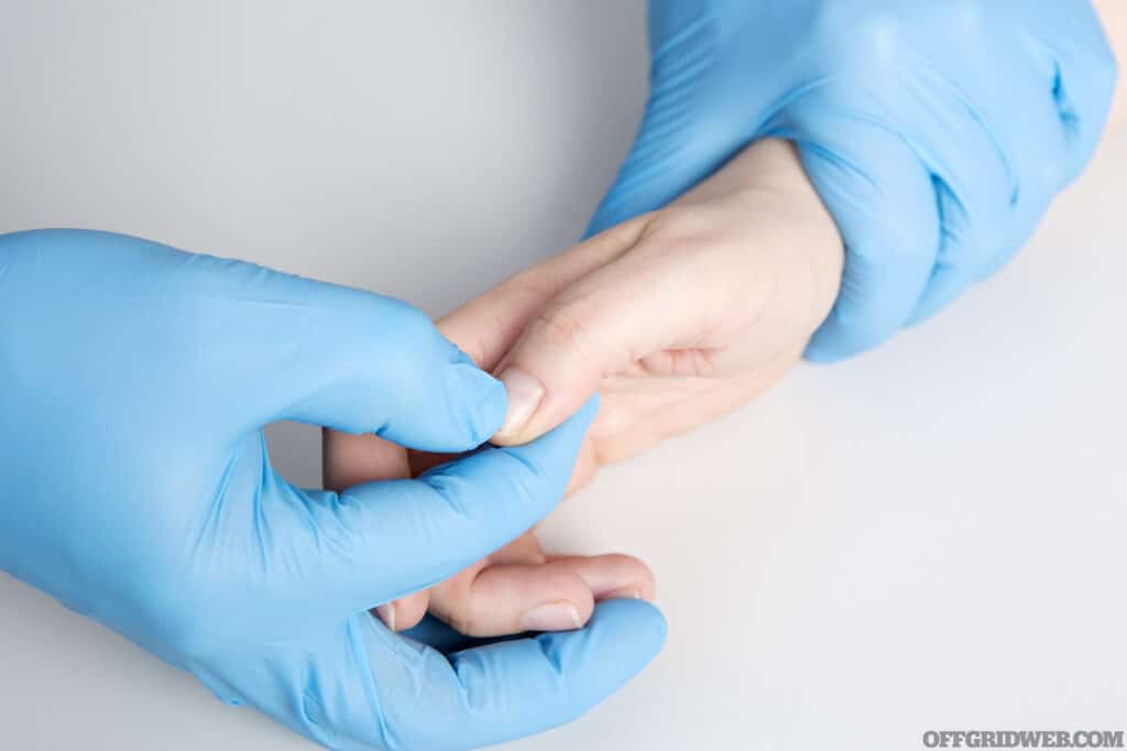 First Aid - doing a Capillary refill test. Capillary refill time is defined as the time taken for color to return to an external capillary bed after pressure is applied to cause blanching.