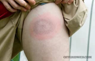 What’s Bugging You: Bug Bites and Stings