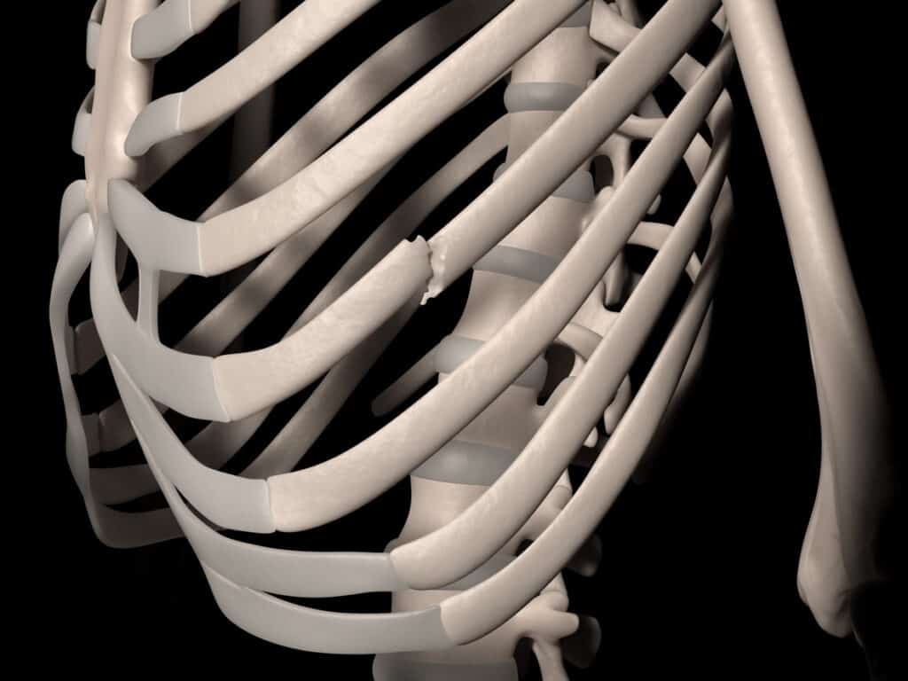 Digital medical illustration depicting a fracture of 7th rib (true rib, vertebrosternal rib, costa vera). Front perspective view.